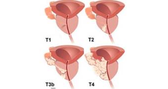 Prostate Cancer doctor lahore