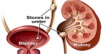 Ureteric Stone doctor lahore